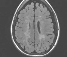 Disruption of White Matter Circuits in Multiple Sclerosis